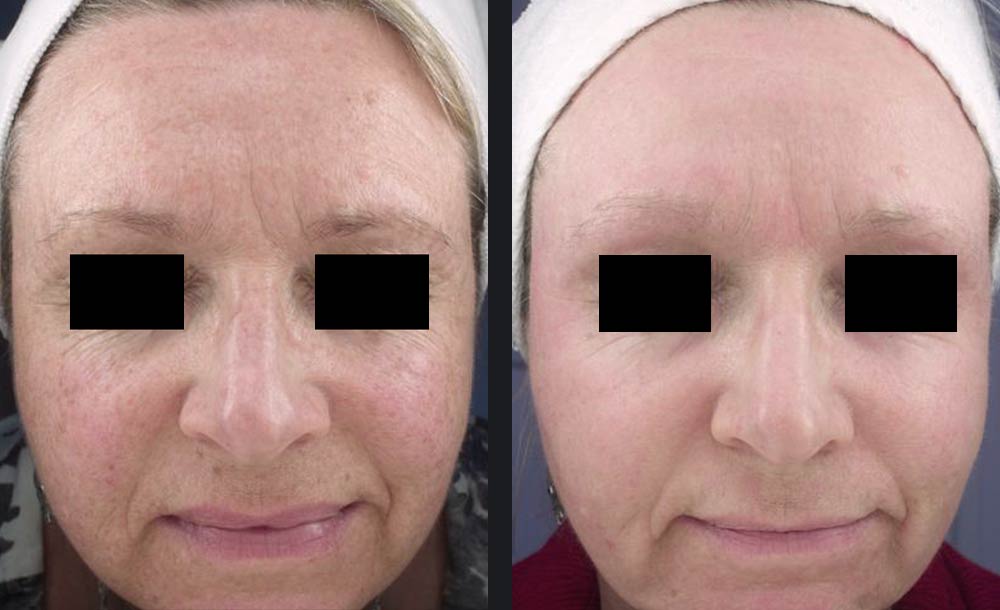 Tratamentul cu laser CO2 Candela pentru rejuvenare  facială